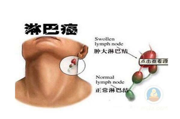 艾滋病常见症状:持续发烧,虚弱,盗汗,全身淋巴结肿大艾滋病是一种危害